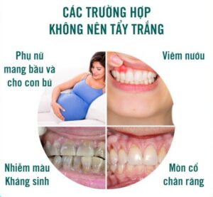 Những trường hợp không nên tẩy trắng răng
