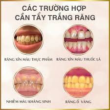 Những trường hợp nên tẩy trắng răng