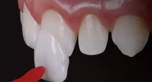 Phương pháp dán sứ veneer