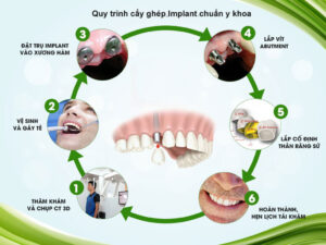 Quy trình cấy ghép implant chuẩn y khoa