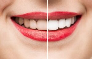 Tẩy trắng răng có an toàn không
