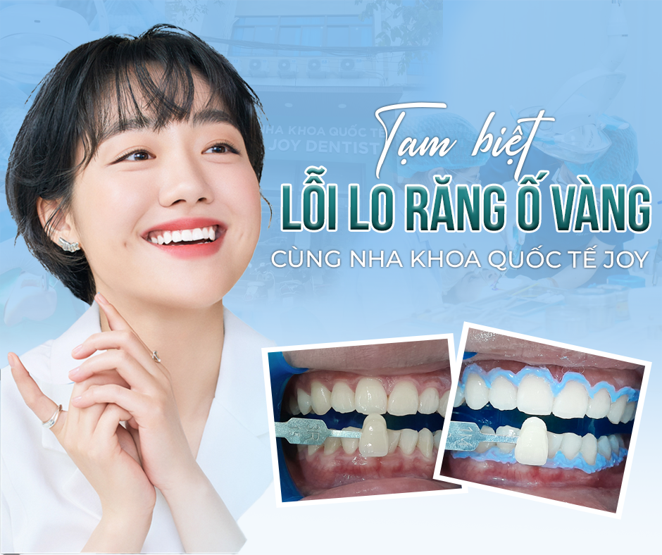 Tẩy trắng răng