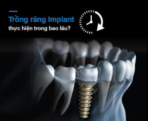Thời gian cấy ghép implant mất bao lâu?