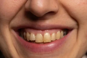Tình trạng răng ố vàng