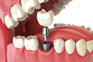 Trồng răng implant là gì