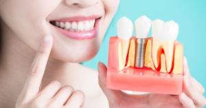 Ưu điểm của trụ implant