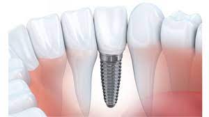 Ưu điểm của trụ implant Biotem