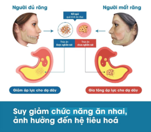 Ảnh hưởng nghiêm trọng đến quá trình ăn nhai