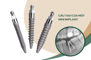 Cấu tạo chi tiết của implant mini