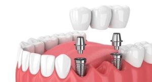 Quy Trình Cấy Ghép Răng Implant