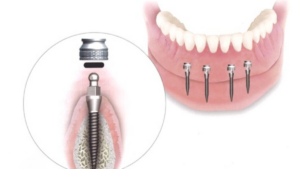 Cấy ghép implant mini được định nghĩa thế nào