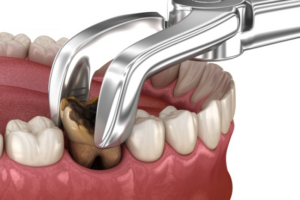 Khi nào thì bắt buộc phải nhổ răng vĩnh viễn