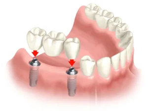 Làm cầu răng sứ khắc phục tình trạng mất răng lâu năm