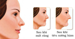 Mất răng vĩnh viễn không trồng lại gây tiêu xương hàm, lão hoá sớm