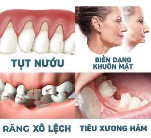 Những hậu quả sau khi mất răng quá lâu