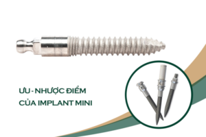 Những ưu điểm nổi bật của implant mini