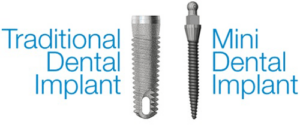 So sánh implant mini và implant truyền thống