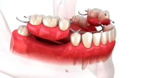 Sử dụng hàm giả tháo lắp