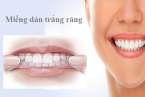Những ưu điểm nổi bật của miếng dán trắng răng