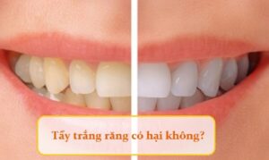 Thuốc tẩy trắng răng có gây hại cho sức khoẻ không