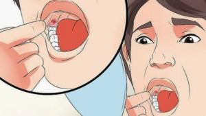 Chăm sóc sau khi nhổ răng khôn có thực sự quan trọng?