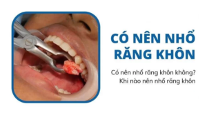 Có nên nhổ răng khôn khôn