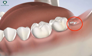 Đối tượng nên nhổ răng khôn hàm dưới