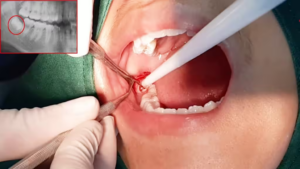 Nhổ răng khôn có ảnh hưởng nhiều đến sức khoẻ không