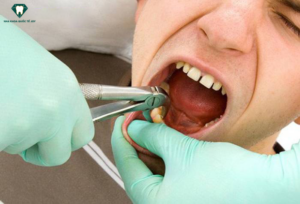 Nhổ răng khôn hàm dưới với phương pháp truyền thống