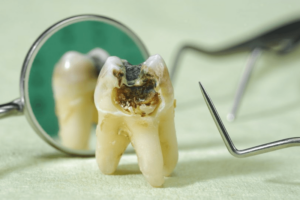 Răng khôn bị sâu do hình dạng của răng