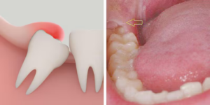 Răng khôn bị sâu do mọc không đúng vị trí