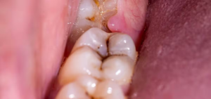 Răng khôn bị sâu gây ra ảnh hưởng thế nào?