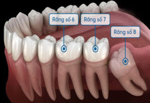 Tổn thương răng số 7