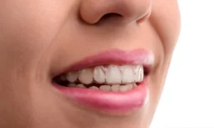 Niềng răng khểnh Invisalign