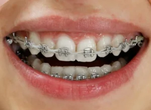 Niềng răng khểnh mắc cài kim loại