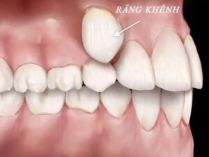 Răng khểnh là gì?